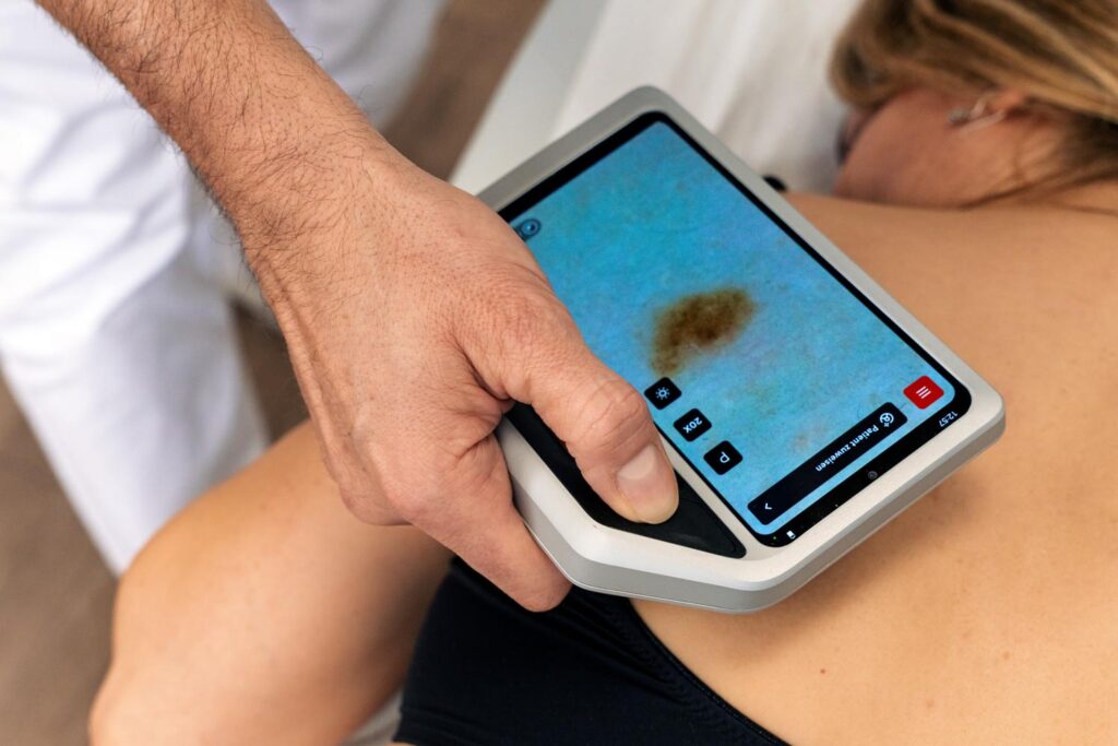 Kleiner Bildschirm mit stark vergrößertem Muttermal beim digitalen Hautkrebs-Screening